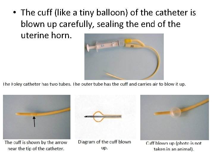  • The cuff (like a tiny balloon) of the catheter is blown up