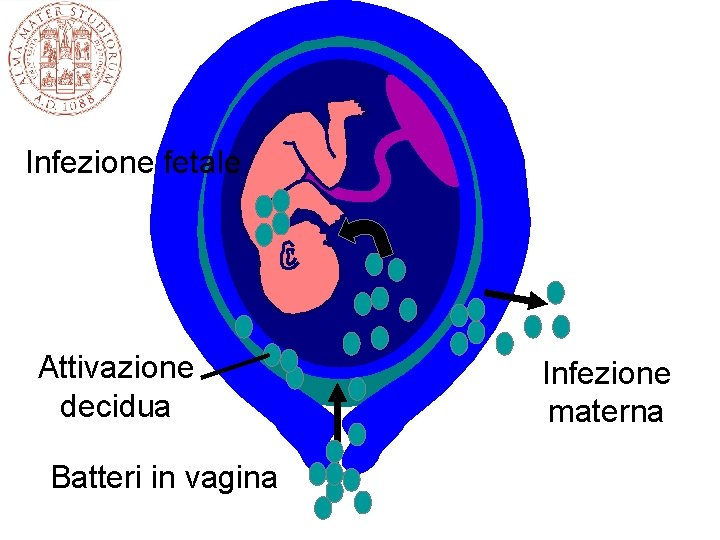 Infezione fetale Attivazione decidua Batteri in vagina Infezione materna 