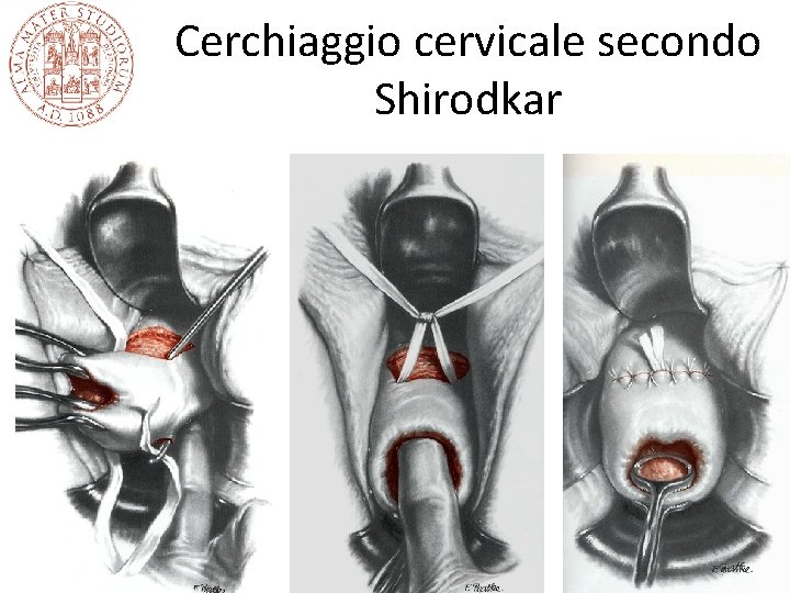 Cerchiaggio cervicale secondo Shirodkar 