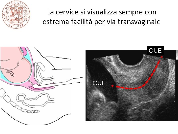 La cervice si visualizza sempre con estrema facilità per via transvaginale OUE * OUI