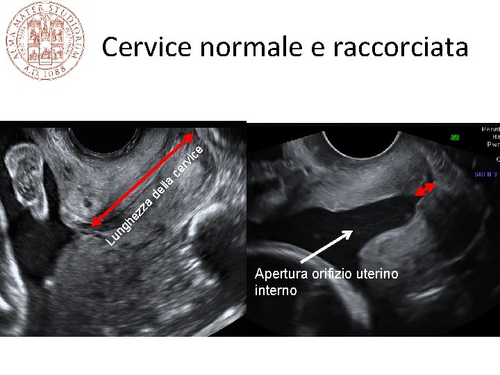 Lu ng he zz a de lla ce rv ic e Cervice normale e