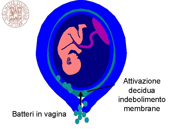 Batteri in vagina Attivazione decidua indebolimento membrane 