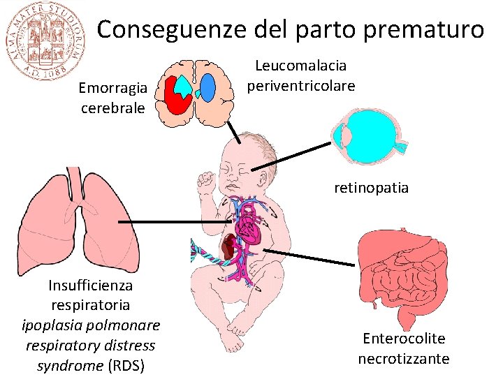 Conseguenze del parto prematuro Emorragia cerebrale Leucomalacia periventricolare retinopatia Insufficienza respiratoria ipoplasia polmonare respiratory