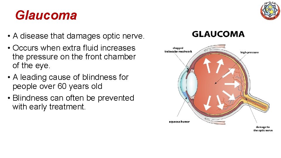 Glaucoma • A disease that damages optic nerve. • Occurs when extra fluid increases