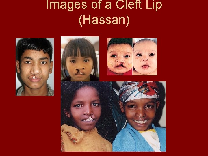 Images of a Cleft Lip (Hassan) 