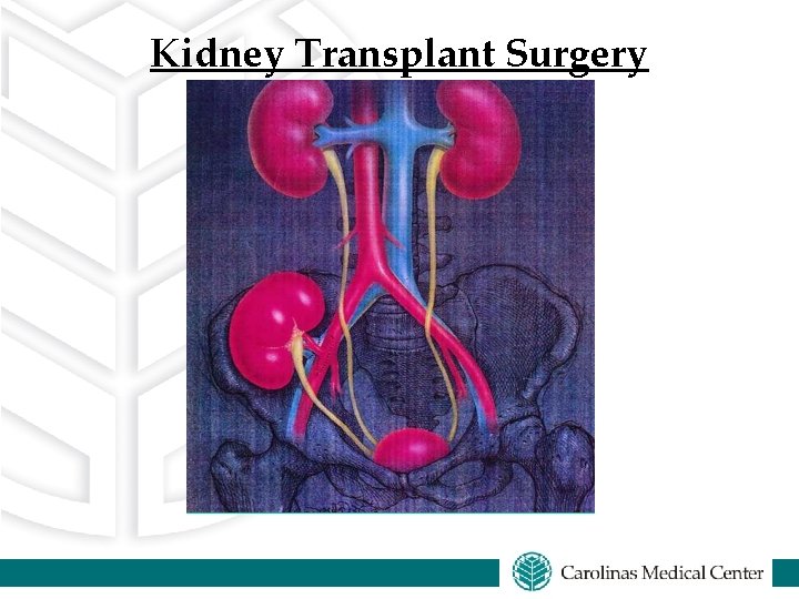 Kidney Transplant Surgery 