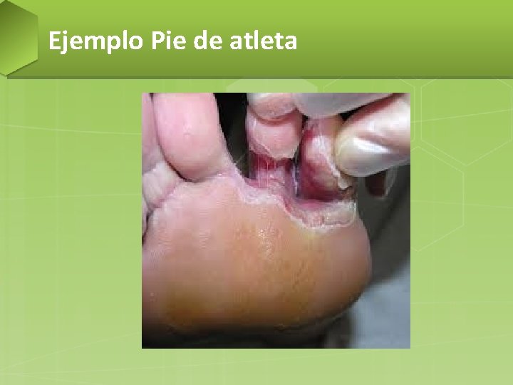 Ejemplo Pie de atleta 