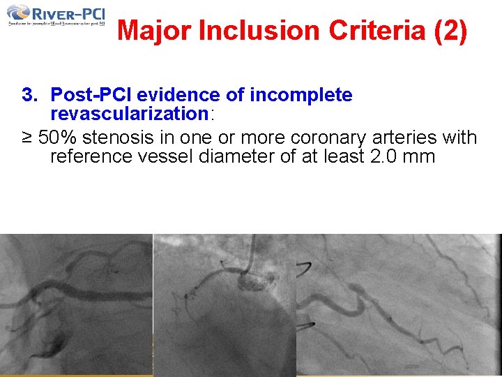 Major Inclusion Criteria (2) 3. Post-PCI evidence of incomplete revascularization: ≥ 50% stenosis in Major Inclusion Criteria (2) 3. Post-PCI evidence of incomplete revascularization: ≥ 50% stenosis in