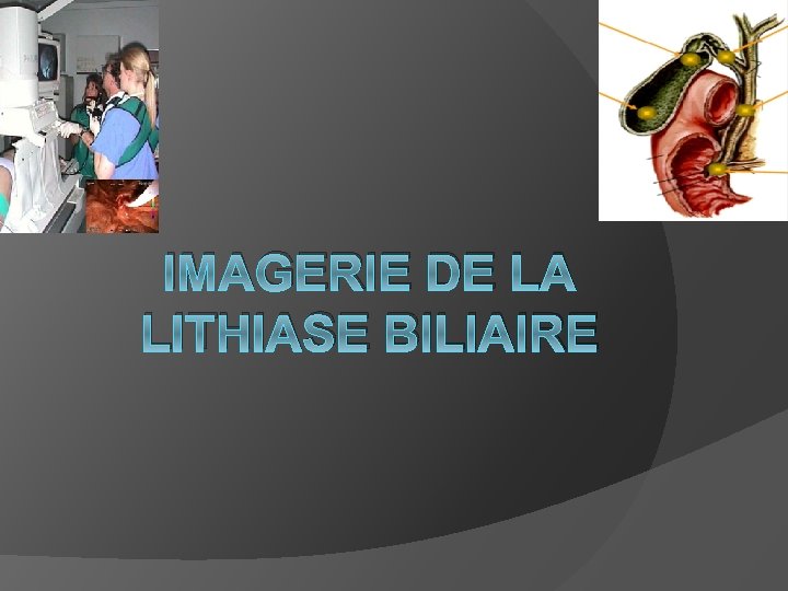 IMAGERIE DE LA LITHIASE BILIAIRE 