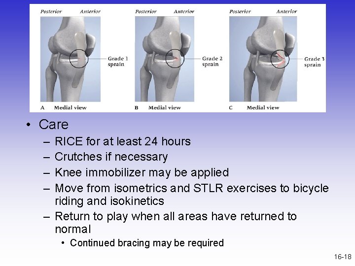  • Care – – RICE for at least 24 hours Crutches if necessary