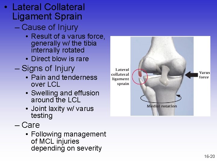  • Lateral Collateral Ligament Sprain – Cause of Injury • Result of a