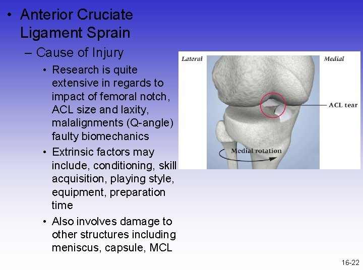  • Anterior Cruciate Ligament Sprain – Cause of Injury • Research is quite