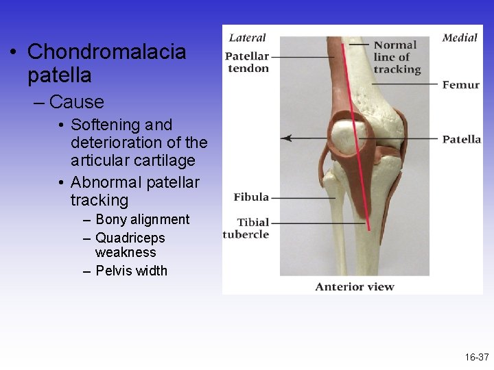  • Chondromalacia patella – Cause • Softening and deterioration of the articular cartilage