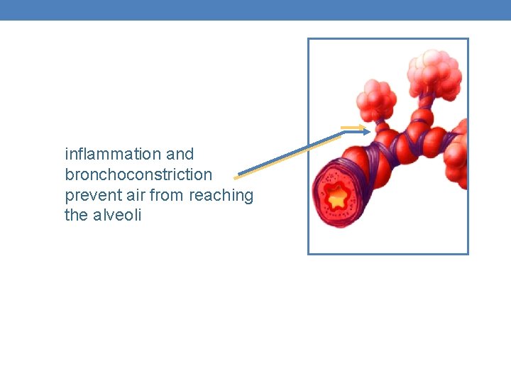 inflammation and bronchoconstriction prevent air from reaching the alveoli 