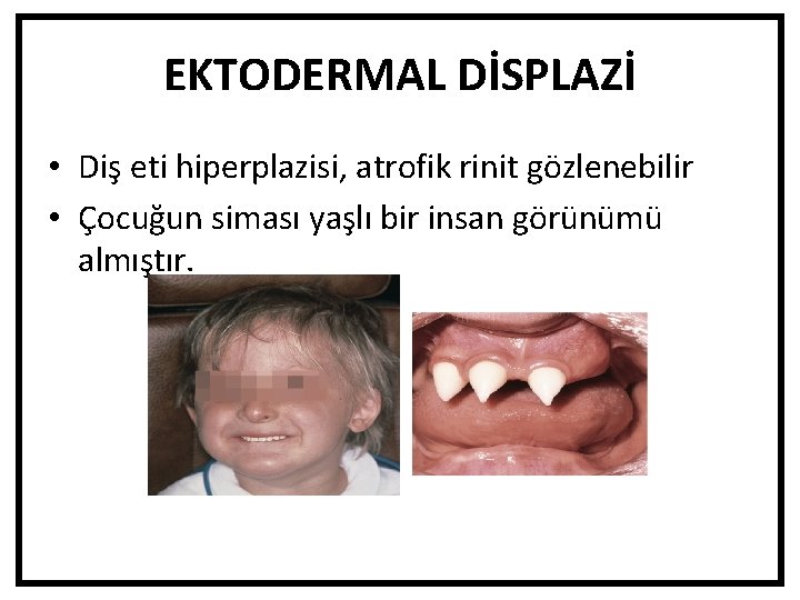 EKTODERMAL DİSPLAZİ • Diş eti hiperplazisi, atrofik rinit gözlenebilir • Çocuğun siması yaşlı bir