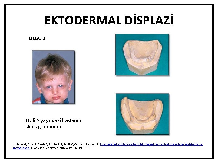 EKTODERMAL DİSPLAZİ OLGU 1 ED’li 5 yaşındaki hastanın klinik görünümü Lo Muzio L, Bucci