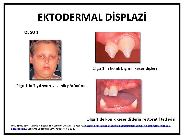 EKTODERMAL DİSPLAZİ OLGU 1 Olgu 1’in konik biçimli keser dişleri Olgu 1’in 7 yıl