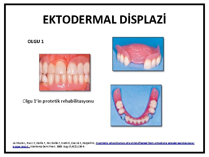 EKTODERMAL DİSPLAZİ OLGU 1 Olgu 1’in protetik rehabilitasyonu Lo Muzio L, Bucci P, Carile