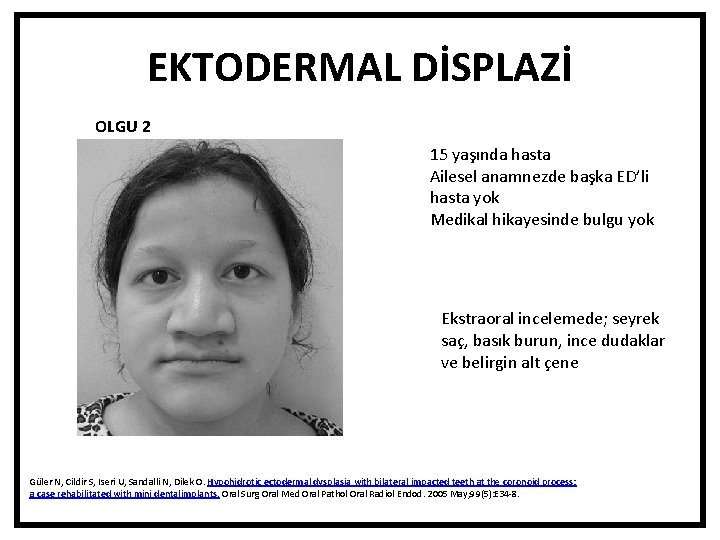 EKTODERMAL DİSPLAZİ OLGU 2 15 yaşında hasta Ailesel anamnezde başka ED’li hasta yok Medikal