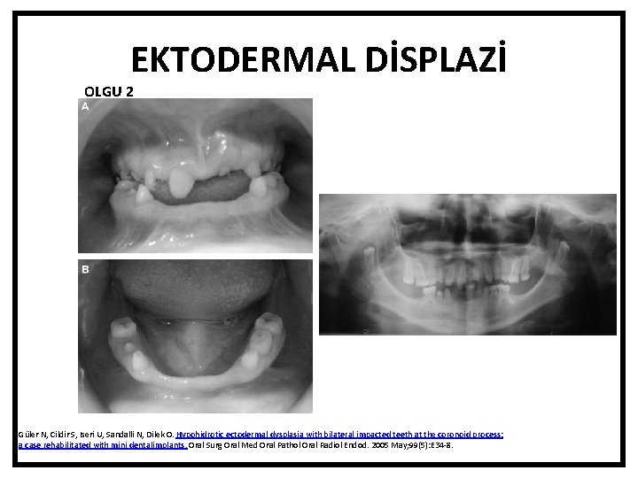 EKTODERMAL DİSPLAZİ OLGU 2 Güler N, Cildir S, Iseri U, Sandalli N, Dilek O.