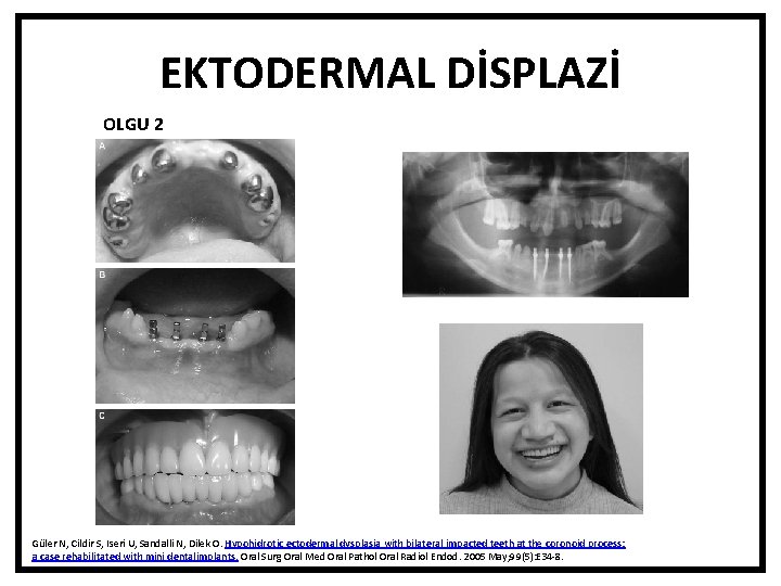 EKTODERMAL DİSPLAZİ OLGU 2 Güler N, Cildir S, Iseri U, Sandalli N, Dilek O.