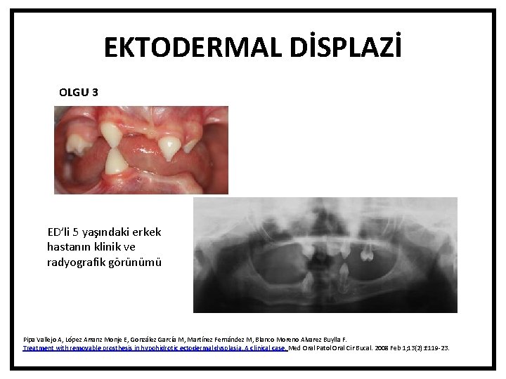 EKTODERMAL DİSPLAZİ OLGU 3 ED’li 5 yaşındaki erkek hastanın klinik ve radyografik görünümü Pipa