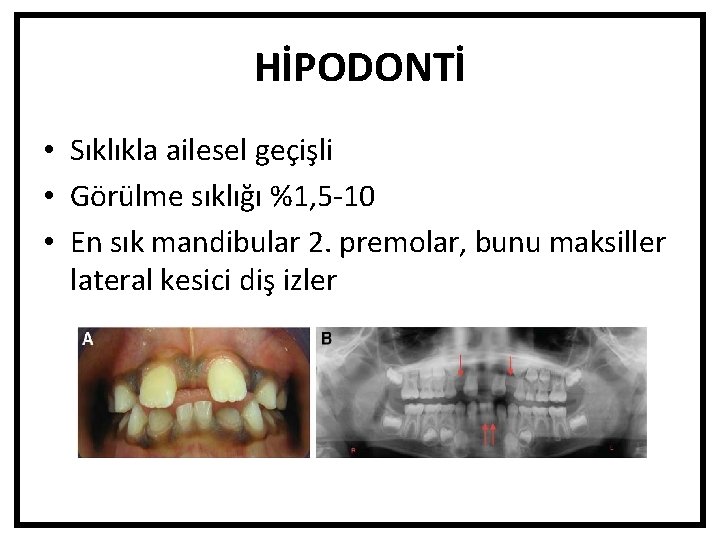 HİPODONTİ • Sıklıkla ailesel geçişli • Görülme sıklığı %1, 5 -10 • En sık