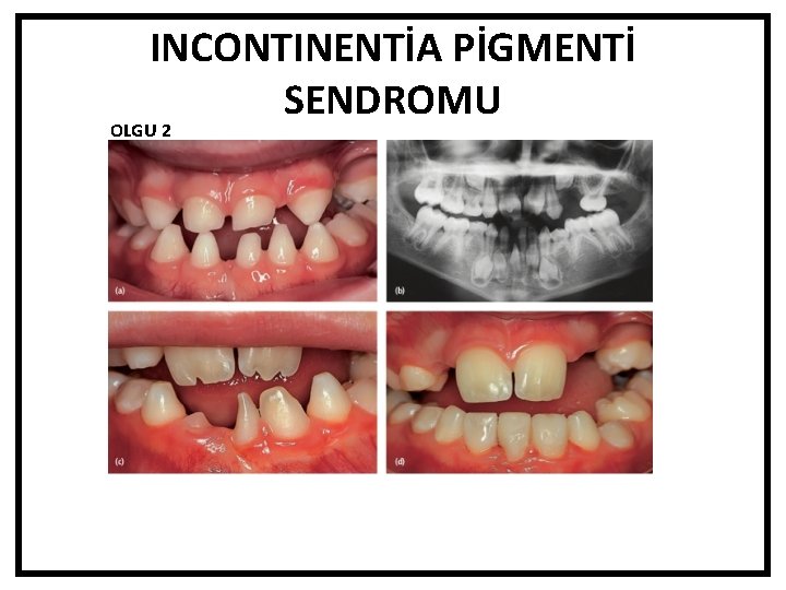 INCONTINENTİA PİGMENTİ SENDROMU OLGU 2 