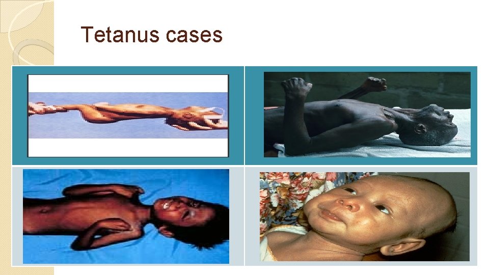 Tetanus cases 