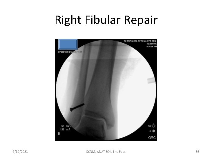 Right Fibular Repair 2/19/2021 SCNM, ANAT 604, The Foot 36 