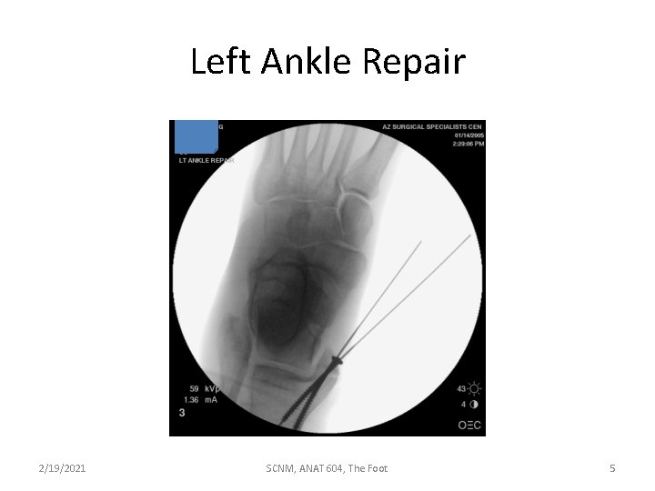 Left Ankle Repair 2/19/2021 SCNM, ANAT 604, The Foot 5 