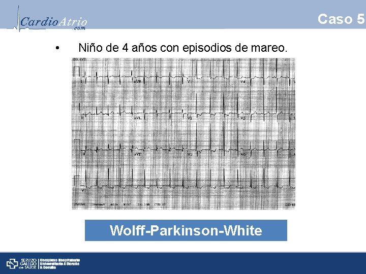 Caso 5 • Niño de 4 años con episodios de mareo. Wolff-Parkinson-White 