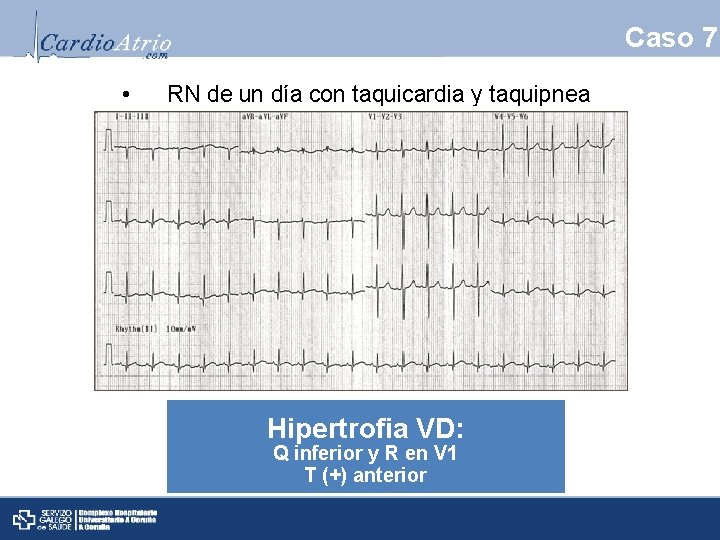 Caso 7 • RN de un día con taquicardia y taquipnea Hipertrofia VD: Q