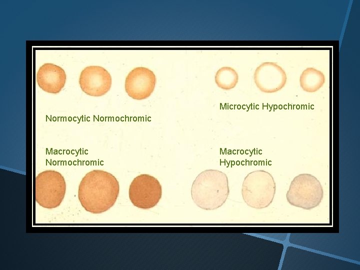 Microcytic Hypochromic Normocytic Normochromic Macrocytic Hypochromic 
