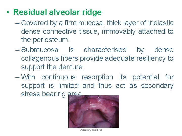  • Residual alveolar ridge – Covered by a firm mucosa, thick layer of