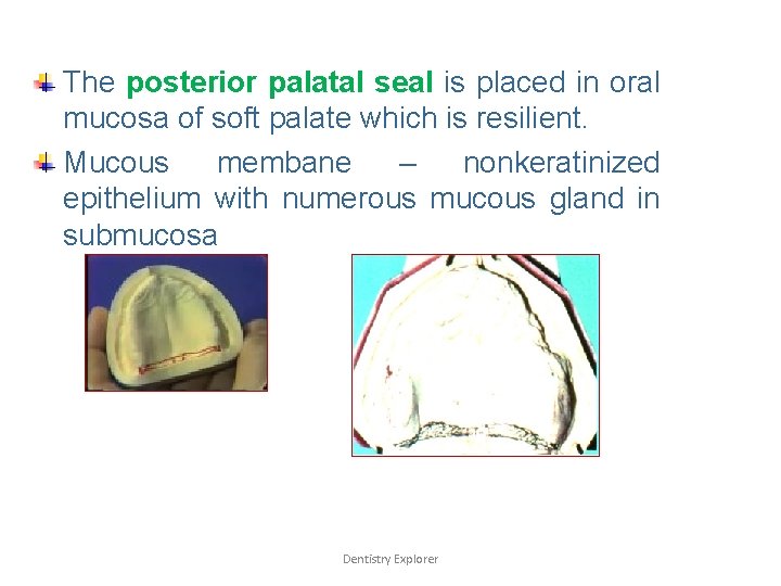 The posterior palatal seal is placed in oral mucosa of soft palate which is