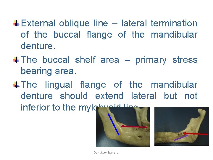 External oblique line – lateral termination of the buccal flange of the mandibular denture.