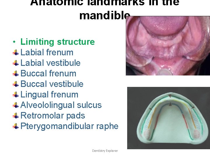 Anatomic landmarks in the mandible • Limiting structure Labial frenum Labial vestibule Buccal frenum