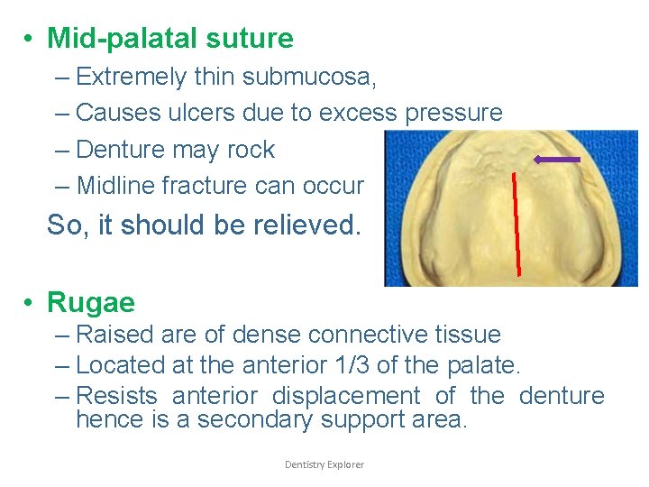  • Mid-palatal suture – Extremely thin submucosa, – Causes ulcers due to excess
