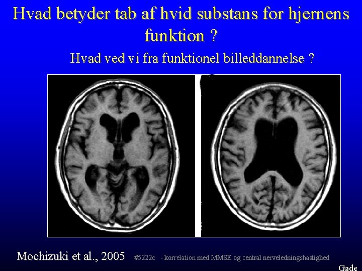 Hvad betyder tab af hvid substans for hjernens funktion ? Hvad ved vi fra