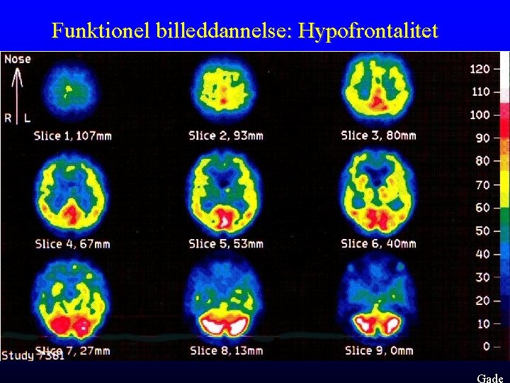 Funktionel billeddannelse: Hypofrontalitet Gade 