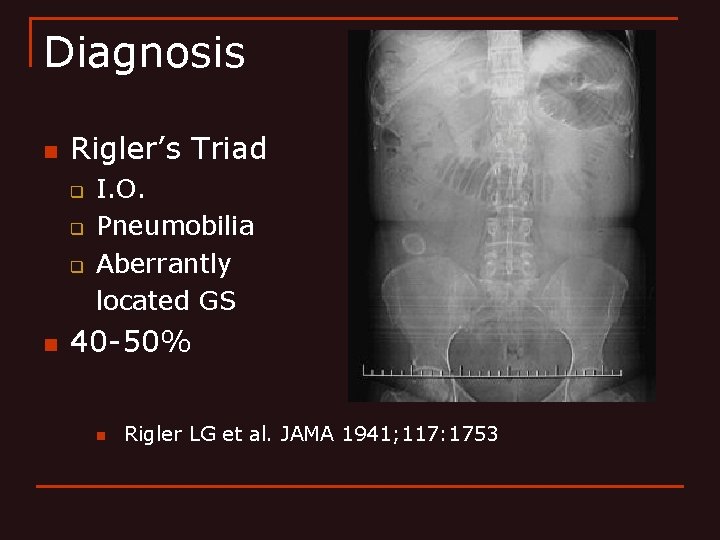 Diagnosis n Rigler’s Triad q q q n I. O. Pneumobilia Aberrantly located GS