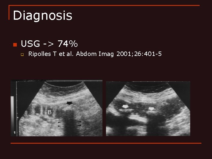 Diagnosis n USG -> 74% q Ripolles T et al. Abdom Imag 2001; 26: