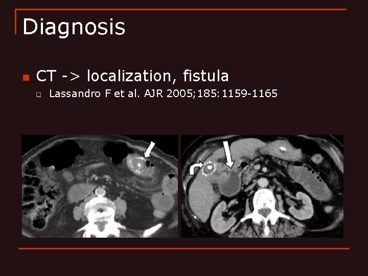 Diagnosis n CT -> localization, fistula q Lassandro F et al. AJR 2005; 185: