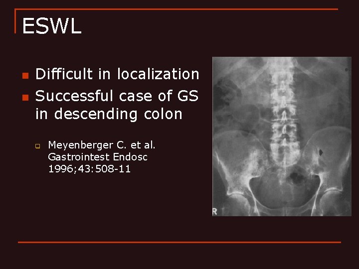 ESWL n n Difficult in localization Successful case of GS in descending colon q