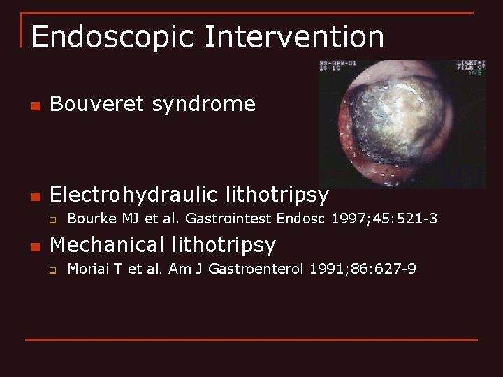 Endoscopic Intervention n Bouveret syndrome n Electrohydraulic lithotripsy q n Bourke MJ et al.