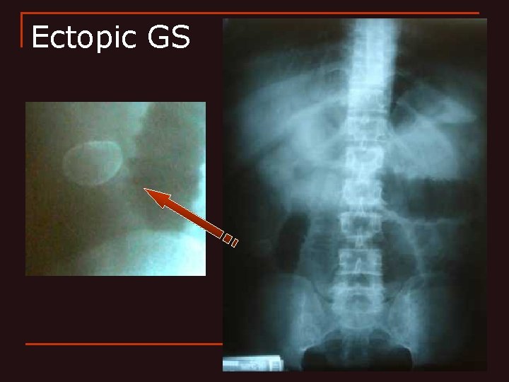 Ectopic GS 