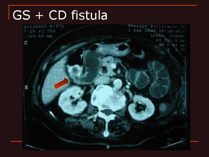 GS + CD fistula 