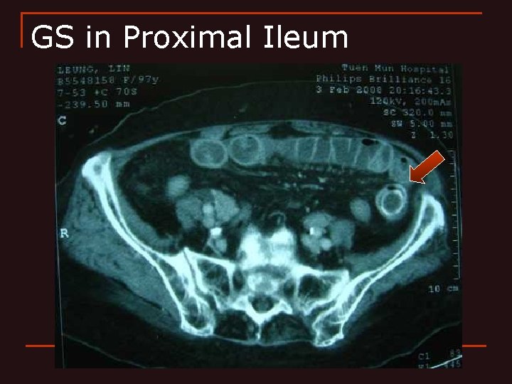 GS in Proximal Ileum 