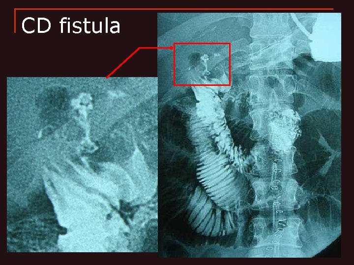 CD fistula 